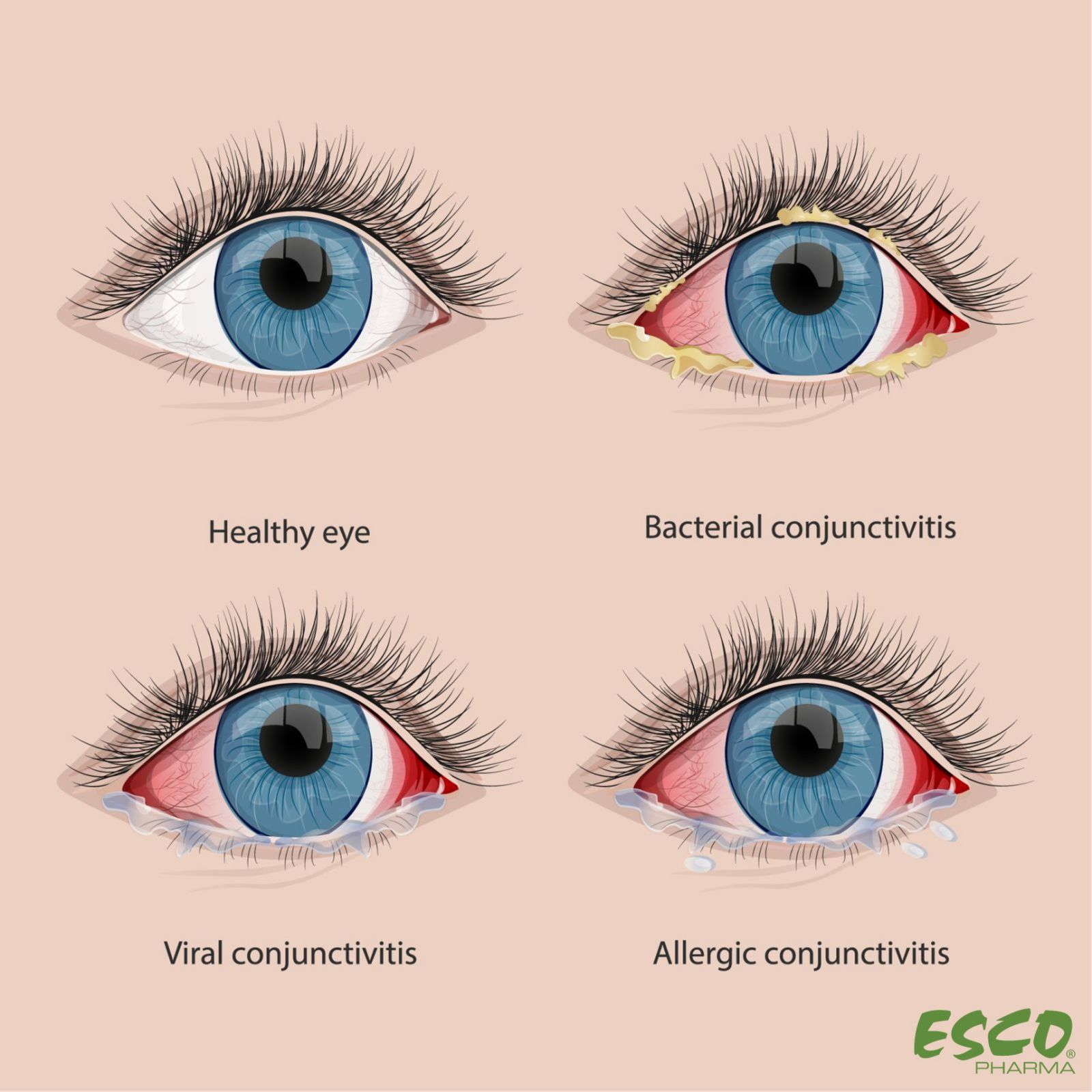 Fig 1 Comparison Of Healthy Eyes And Conjunctivitis 