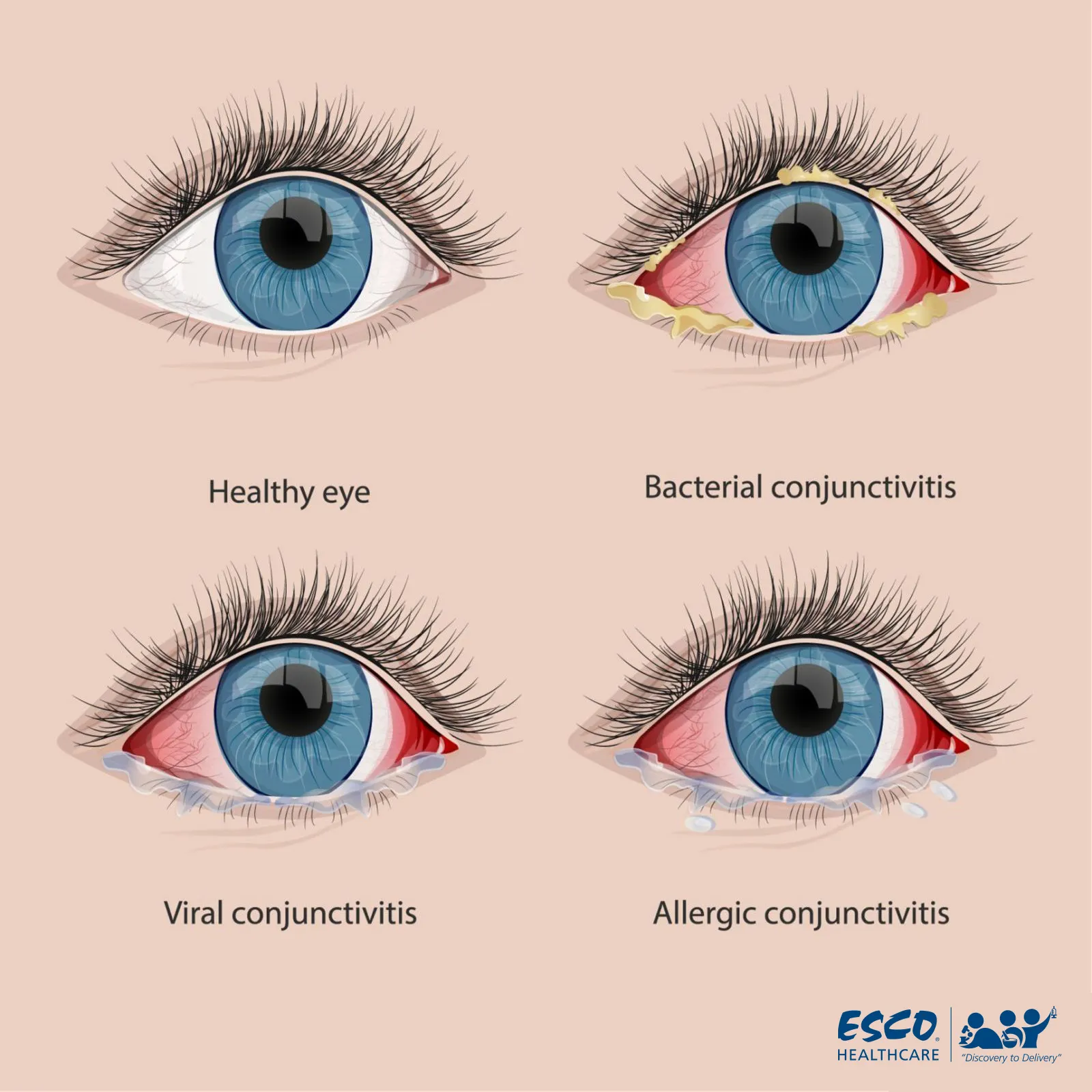 Fig. 1 Comparison of Healthy Eyes and Conjunctivitis